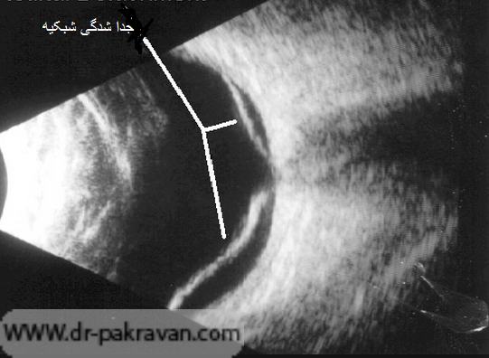 برای تشخیص جداشدگی شبکیه می‌توان از دستگاه سونوگرافی استفاده کرد.